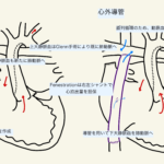 Fontan手術の周術期管理