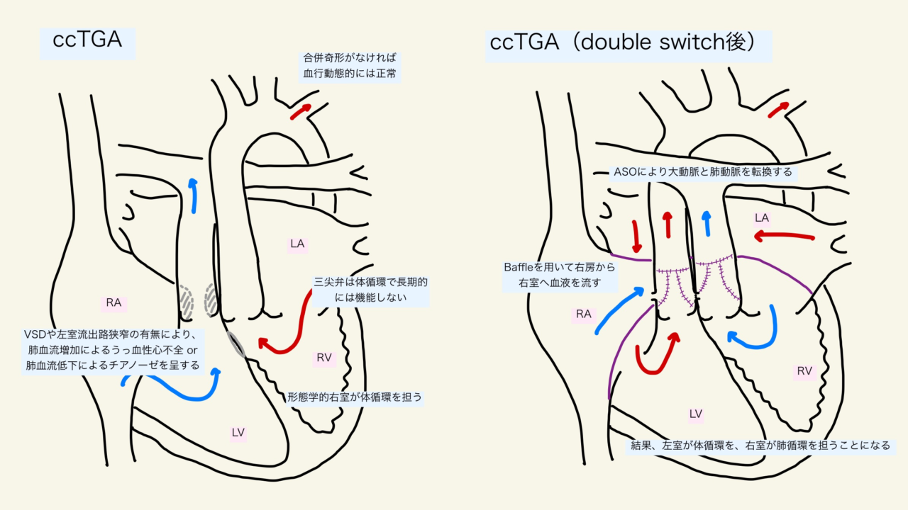 修正大血管転位 L Tga Cctga の周術期管理 シェアする挑戦者 Md Mph