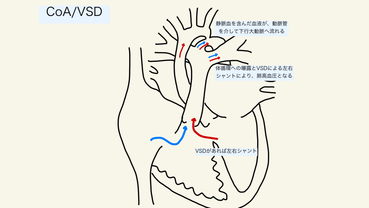 大動脈縮窄症の血行動態と麻酔管理｜シェアする挑戦者 〜 MD × MPH